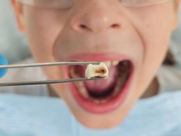 Best Emergency Dentist for Lost Fillings or Crowns in La Grulla, TX